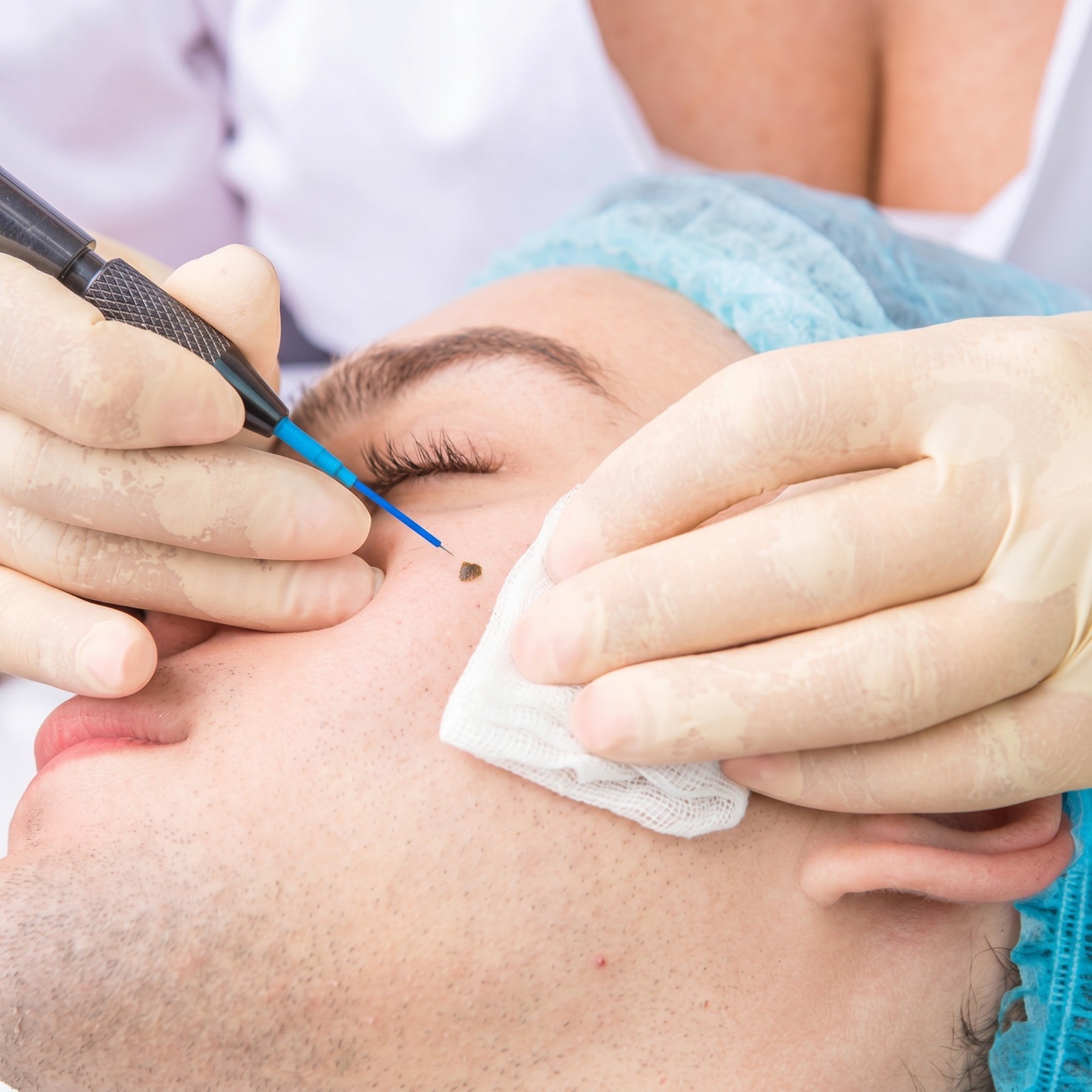 Radio cautery procedures at COSMALIFE SKIN CLINIC